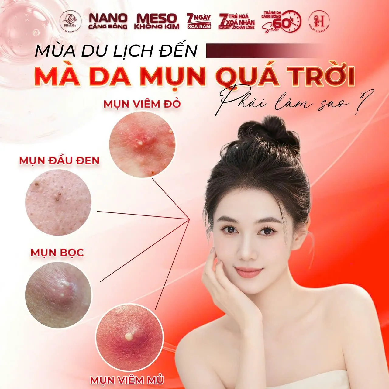 Poster phân biệt các loại mụn và hướng chăm sóc da mụn của HC Pharma