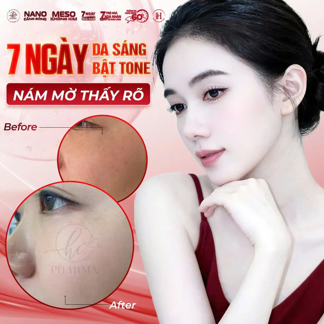 Hình trước và sau sử dụng giải pháp chăm sóc da hỗ trợ cải thiện nám của HC Pharma