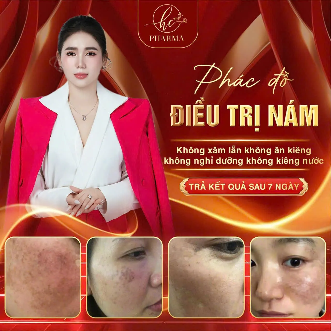 Poster phác đồ điều trị nám với hình ảnh da trước và sau