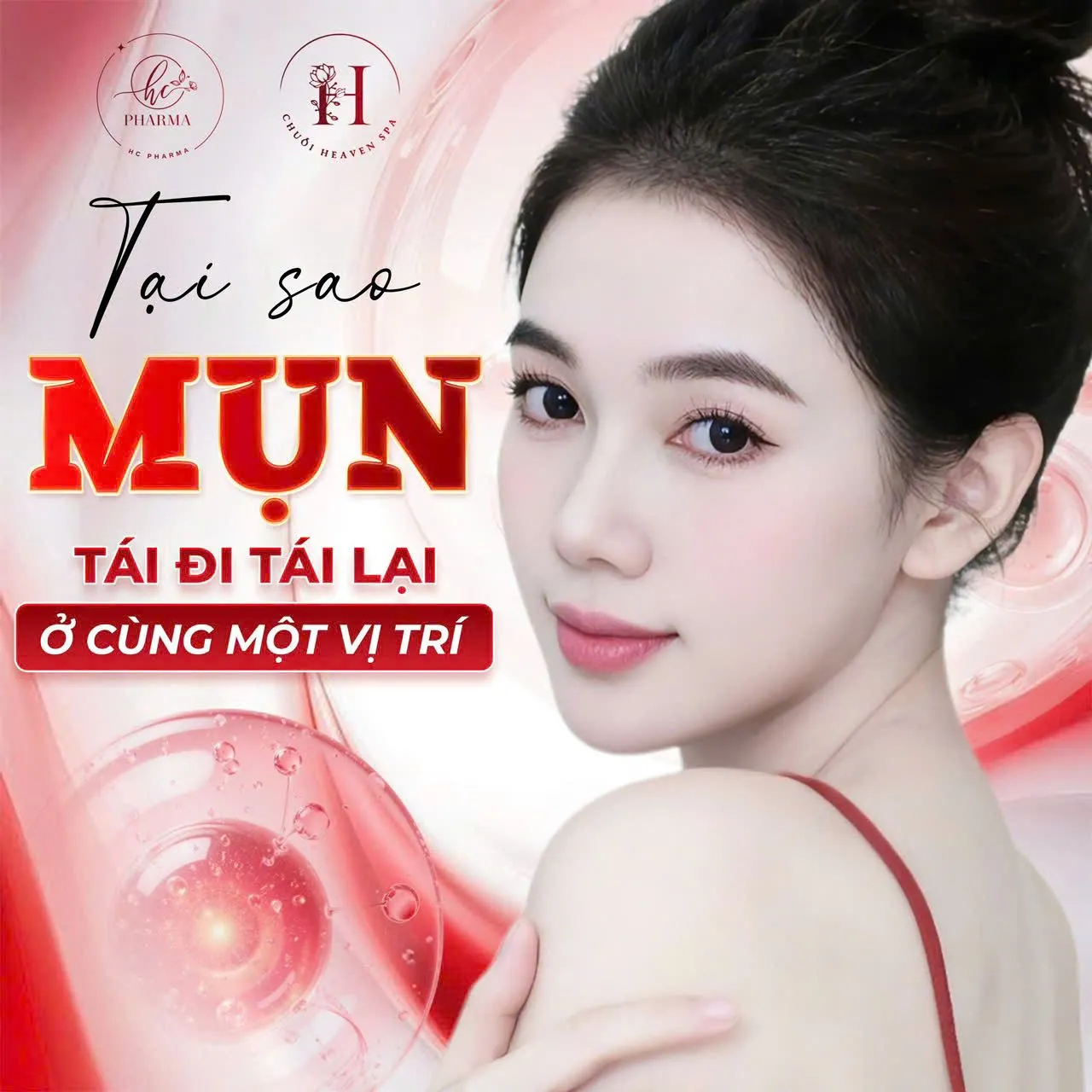 Poster giải thích nguyên nhân mụn tái đi tái lại ở cùng một vị trí