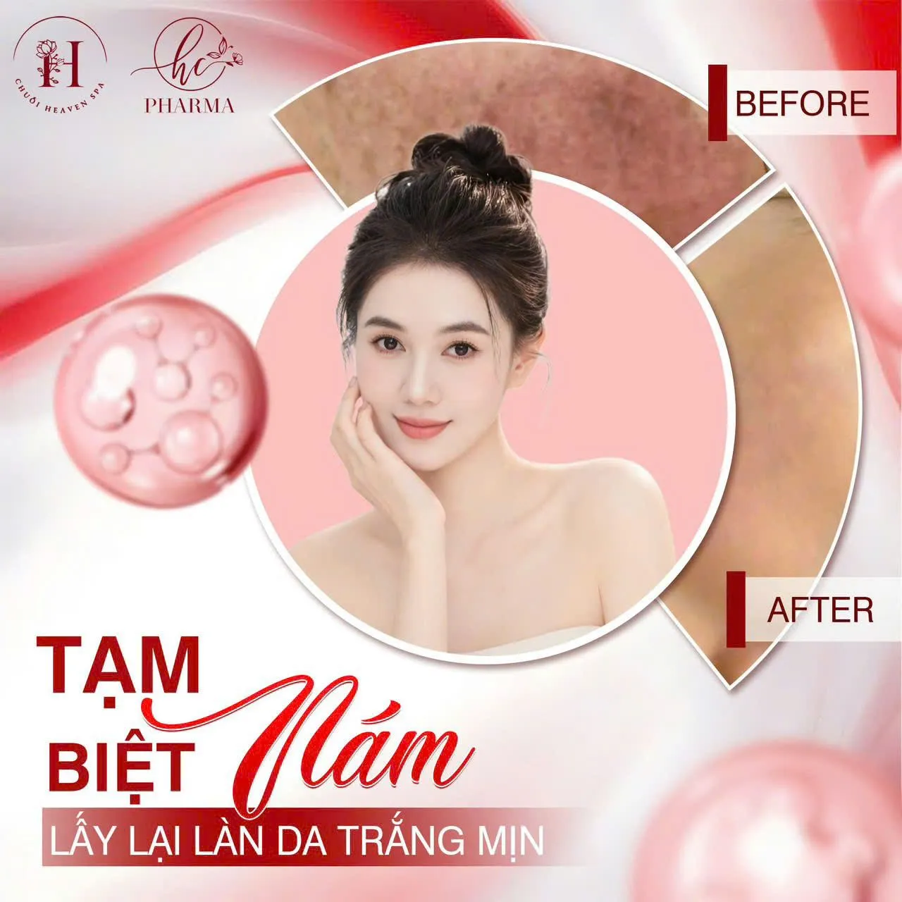 Poster giải pháp hỗ trợ cải thiện nám, hướng tới làn da trắng mịn